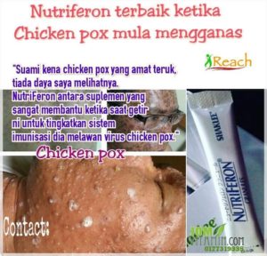 testimoni nutriferon shaklee chickenpox